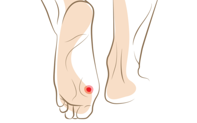 When Should You Seek Treatment for Corns and Calluses?